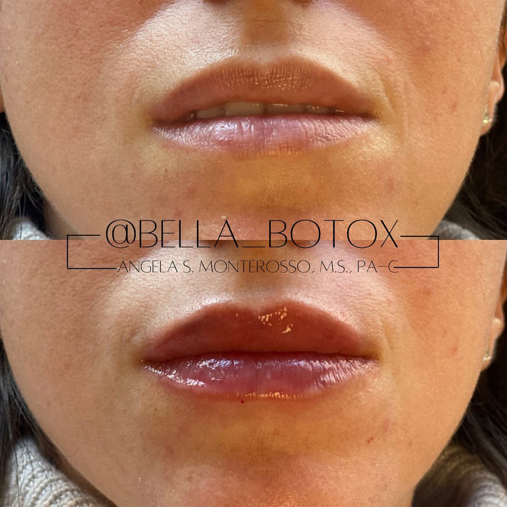 Real patient Lip Augmentation by ECA Plastic Surgery, New Jersey