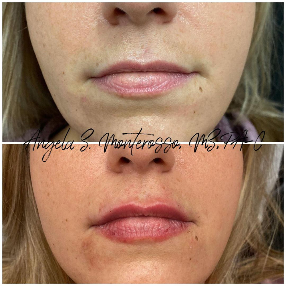 Real patient Lip Augmentation by ECA Plastic Surgery, New Jersey