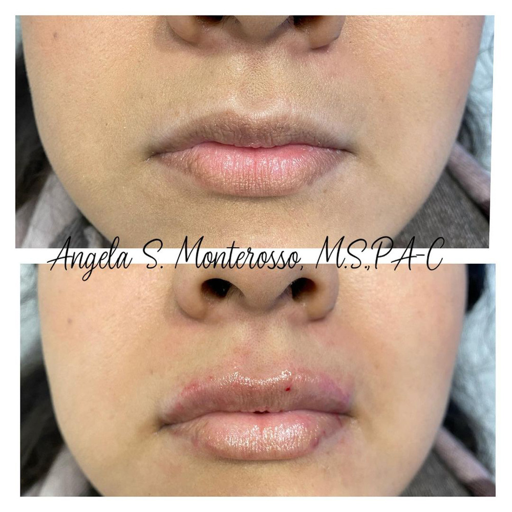 Real patient Lip Augmentation by ECA Plastic Surgery, New Jersey