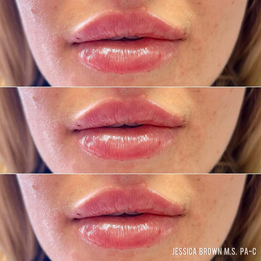 Real patient Lip Augmentation by ECA Plastic Surgery, New Jersey